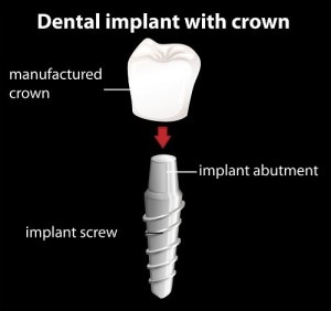 Dental implant with crown illustration