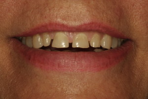 yellow and chipped teeth