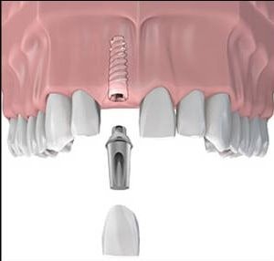 Image of Dental Implant