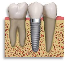 dental implant image