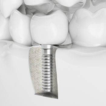 Virtual model of a dental implant surrounded by natural teeth