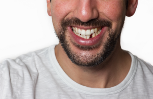 close-up of middle-aged man's smile with a missing tooth