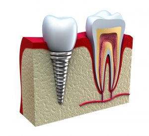virtual model of a dental implant next to an infected tooth