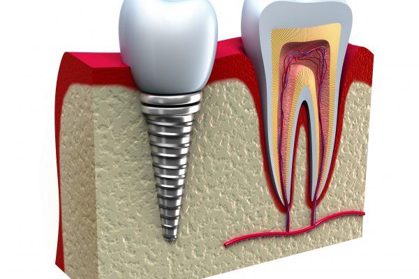 virtual model of a dental implant next to an infected tooth